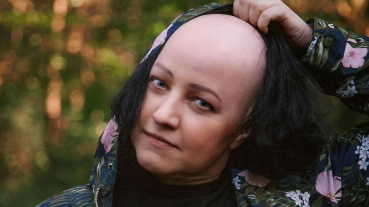 Marta Kawczyńska cierpi na łysienie plackowate