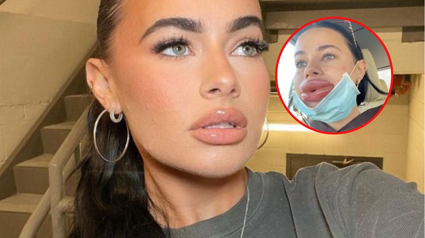 Jej usta podwoiły swój rozmiar po wypełniaczu ust