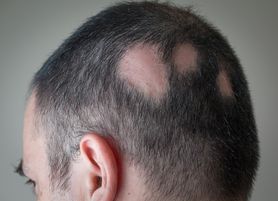 Alopecja – przyczyny, objawy i leczenie