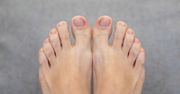 Twoje paznokcie u stóp tak wyglądają? Biegiem do lekarza