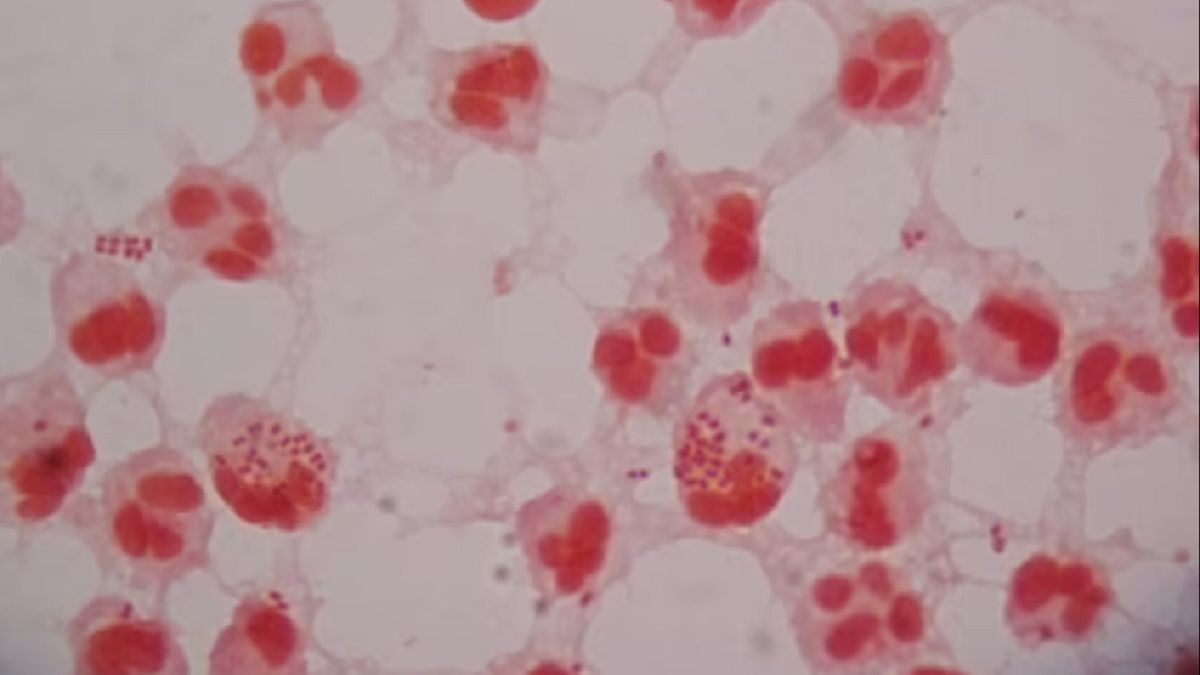 Brytyjczycy mają problem z rzeżączką. Lekarze alarmują