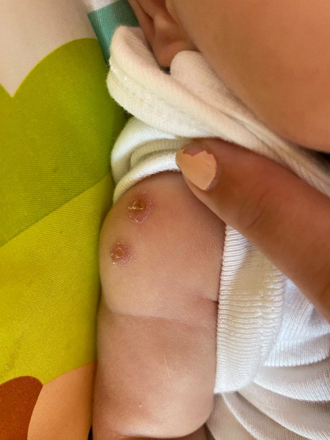 Jeden z bliźniaków został zaszczepiony dwa razy