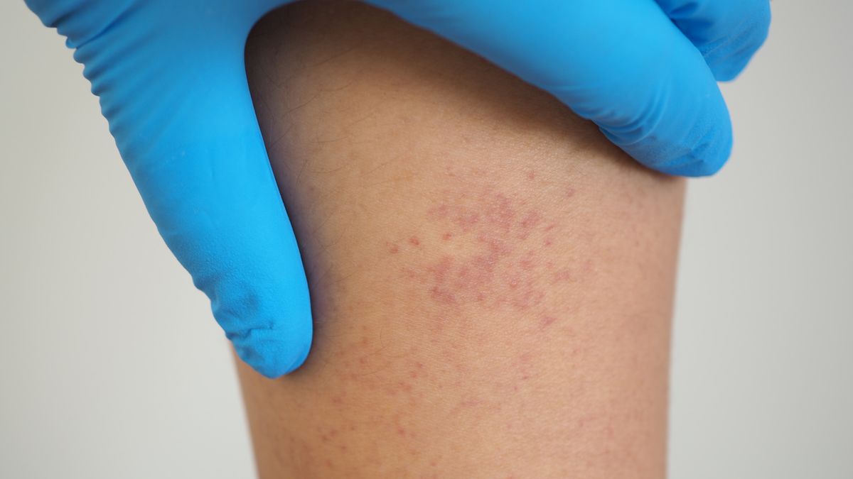 Małopłytkowość w ciąży może objawiać się krwawymi podbiegnięciami