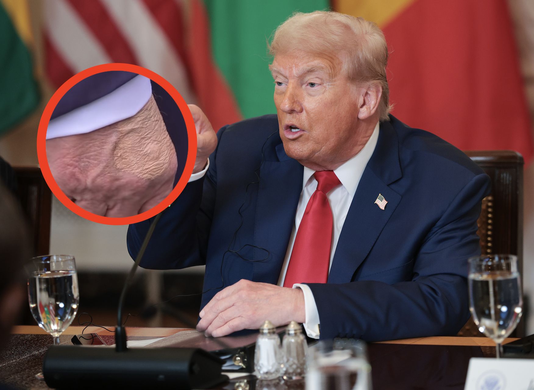 Dłoń prezydenta Donalda Trumpa skupia uwagę mediów.