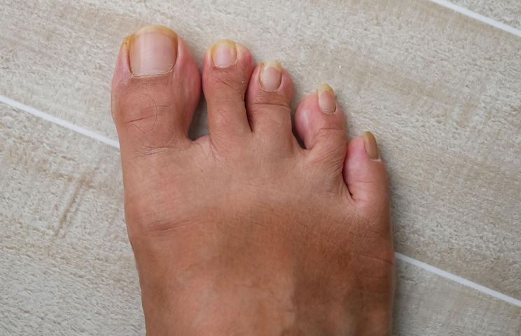 Zżółkniałe paznokcie to jeden z najczętszych objawów cukrzycy typu 2