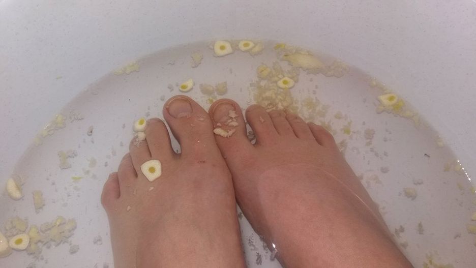 Kuracja z czosnkiem pomoże na grzybicę stóp