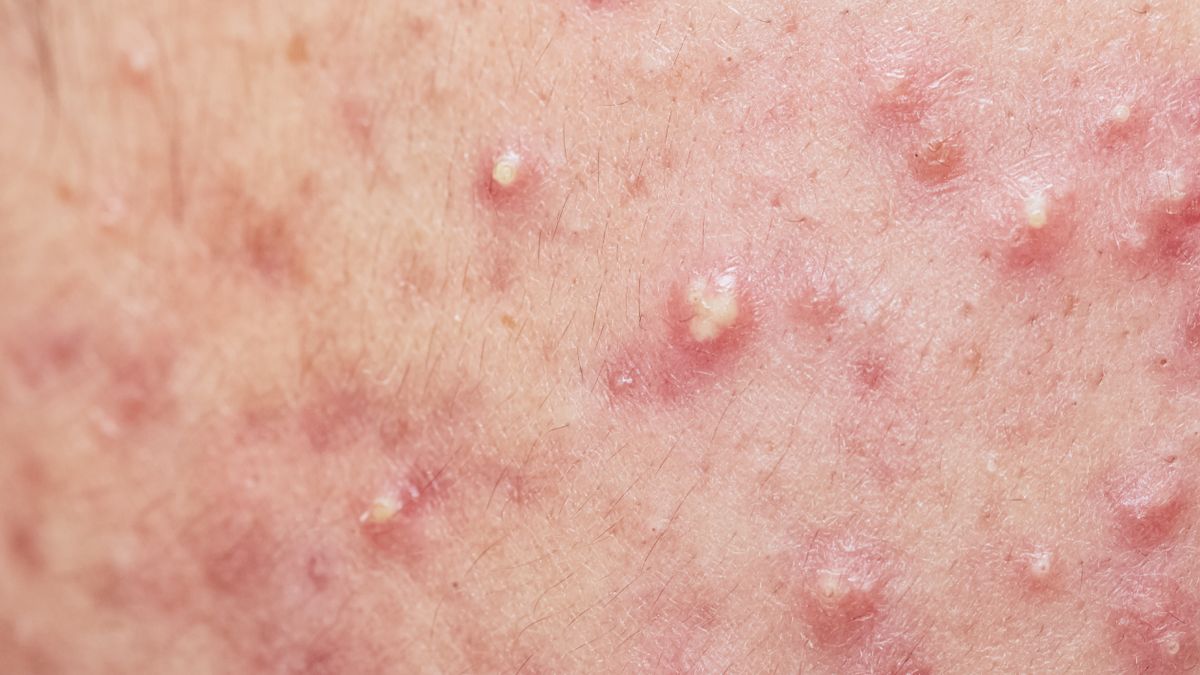 Trądzik ropowiczy stanowi jedną z odmian trądziku pospolitego.