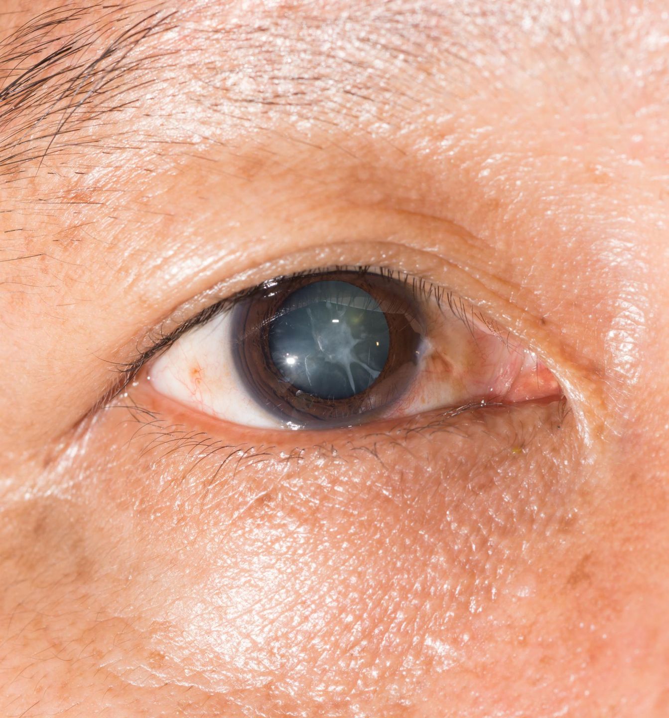 Zaćma może doprowadzić do utraty wzroku