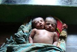 Dwugłowe dziecko zmarło, bo rodzice byli biedni