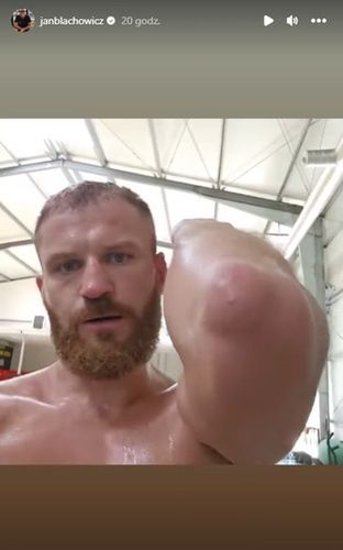 Na zdjęciu: Jan Błachowicz pokazuje stan swojego łokcia.