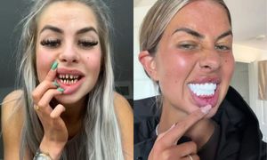 Zrobili sobie "tureckie zęby". Dentysta załamuje ręce