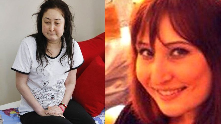 Sevinc Ceklik po amputacji kończyn i przed operacją plastyczną