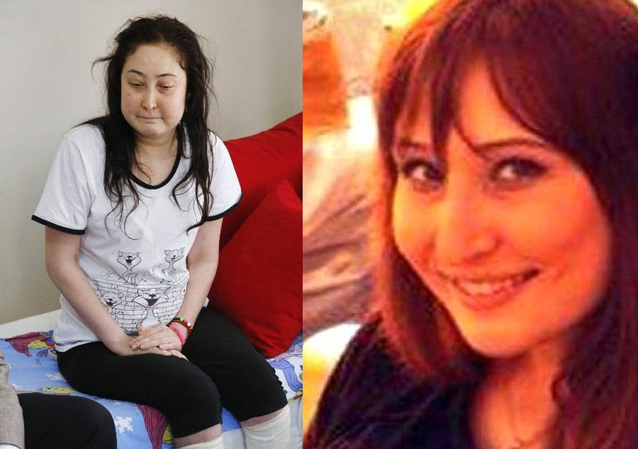 Straciła nogi na skutek zatrucia krwi po operacji plastycznej nosa. 6 lat walczy o odszkodowanie