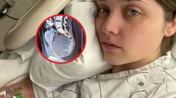 Bolały ją plecy. Guz był już wielkości główki dziecka