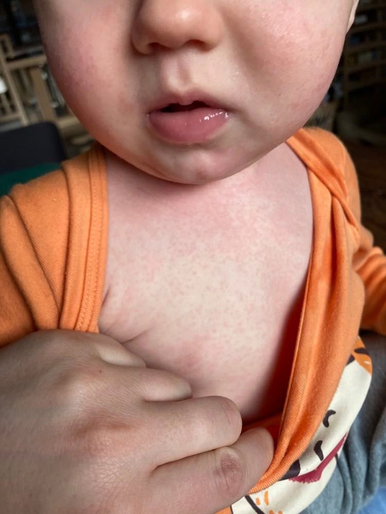 Na ciele chłopca pojawiła się wysypka