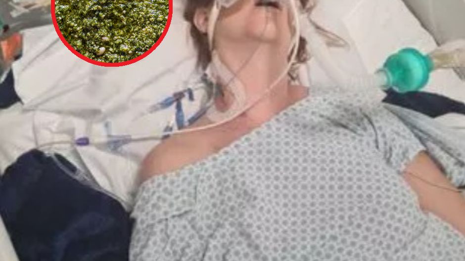 Organizm kobiety "wyłączył się" po zjedzeniu pesto. W szpitalu spędziła rok