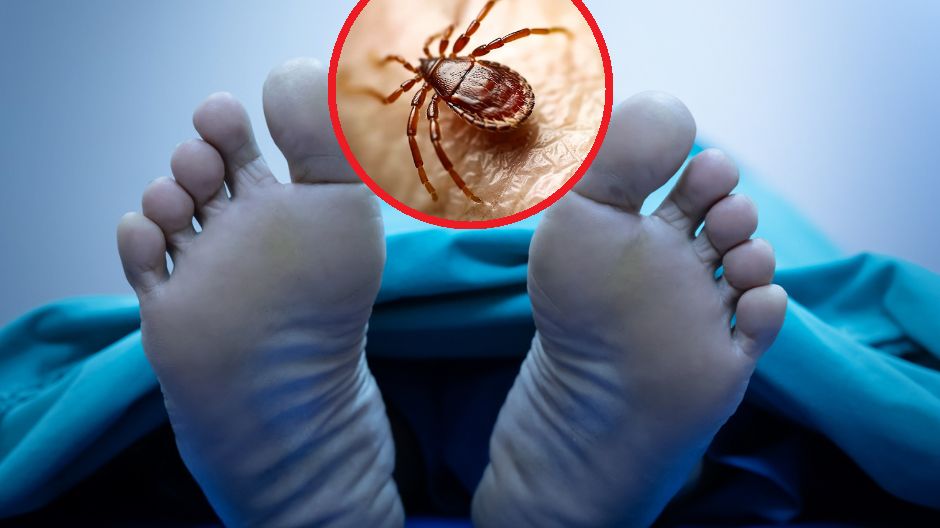 Ukąsił go kleszcz. Mężczyzna zmarł w szpitalu z powodu gorączki krwotocznej