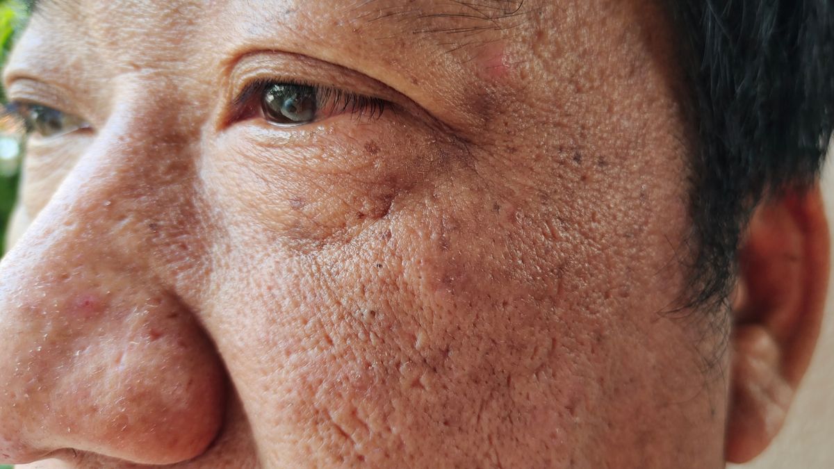 Objaw chorej wątroby widać w oczach