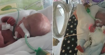 Michalina ważyła 370 g, miała 27 cm. Możemy pomóc w leczeniu i rehabilitacji dziewczynki