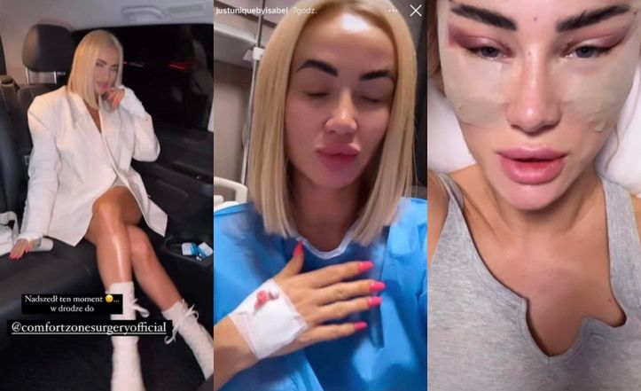 Izabela Macudzińska promuje turecką klinikę, w której poszła pod nóż
