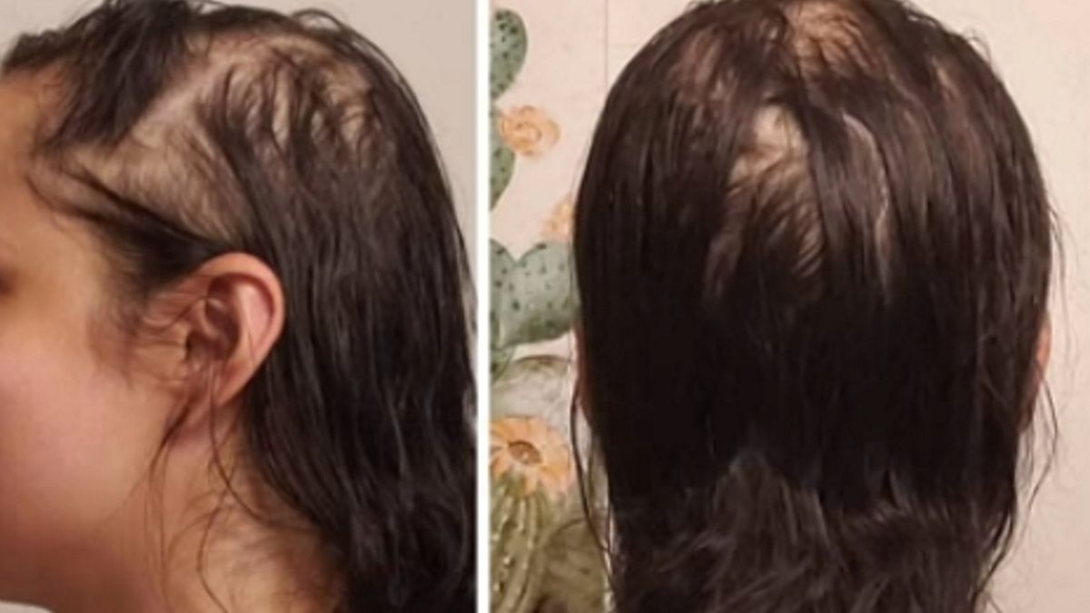 Naukowcy, którzy analizowali długoterminowe objawy po przejściu koronawirusa odkryli, że łącznie 359 pacjentów z 1655 cierpiało na wypadanie włosów. 