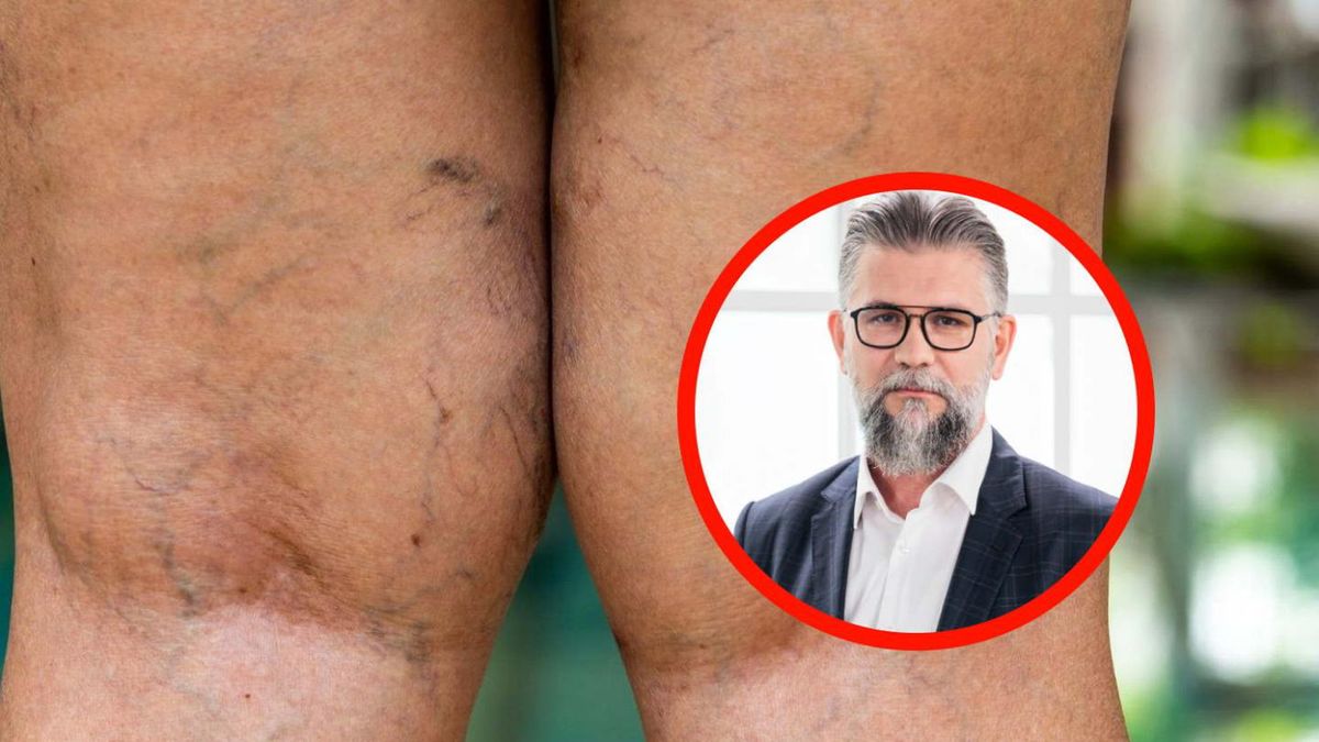 Lekarz ostrzega Polaków. "Cholesterol jest jak kamień w rurach"