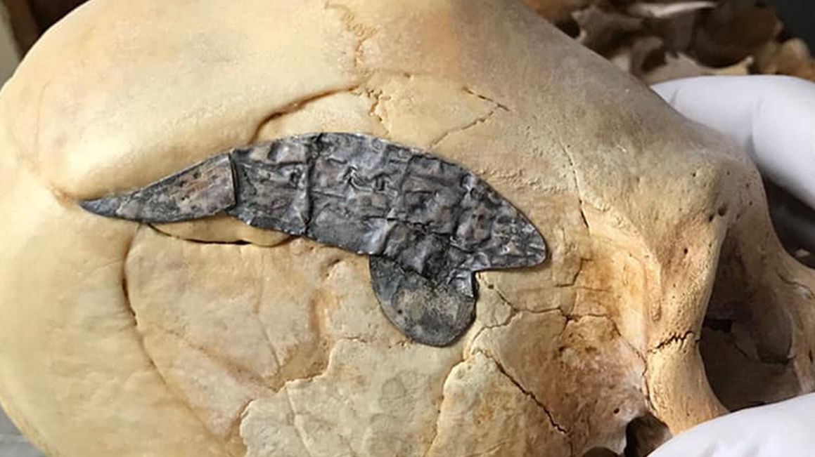 Właściciel czaszki przeszedł skomplikowaną operację 