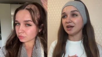 Robiła ciasto na święta, przeżyła horror. Mikser "pożarł" jej włosy