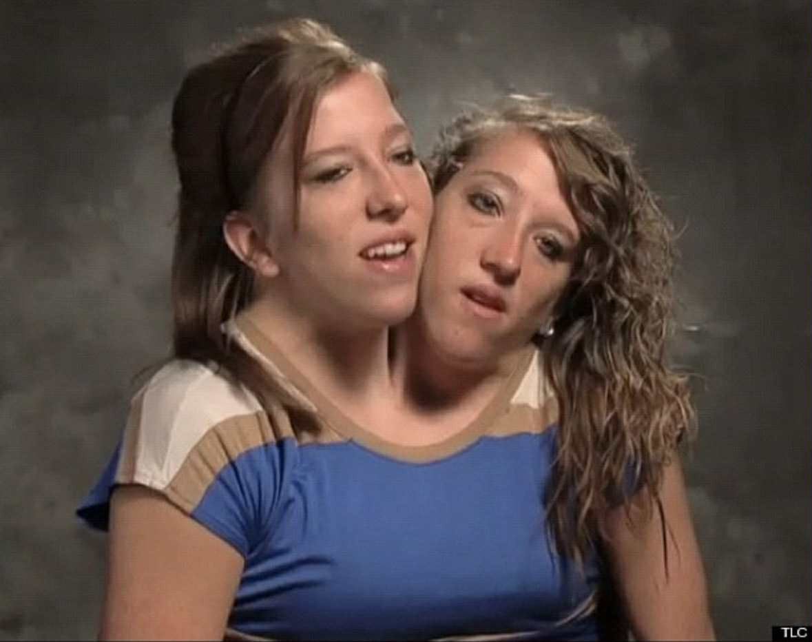 Abby i Brittany Hensel 