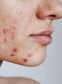 How to get rid of acne. Natural treatments and when should we see a doctor