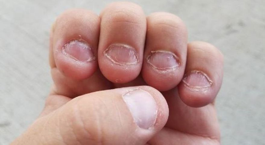 Obgryzanie paznokci może być przyczyną sepsy