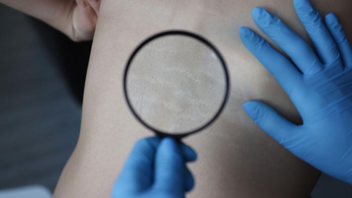 Rozstępy na plecach pojawiają się najczęściej u chłopców w okresie dojrzewania i szybkiego wzrostu.