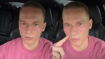 "Jestem prawdziwy Justin Bieber". Schorowany milioner rozpływa się nad swoim wyglądem