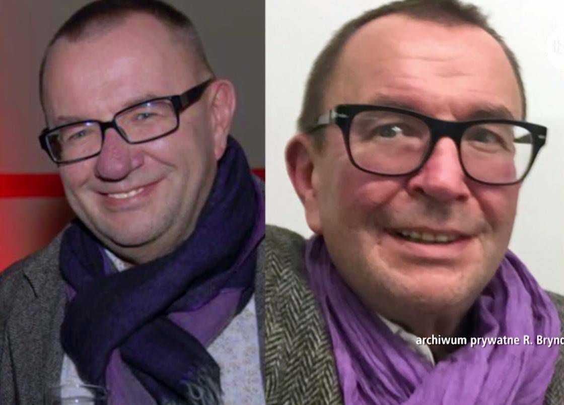 Nosa Rafała Bryndala - zdjęcia przed i po