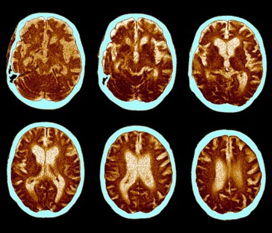 Test na Alzheimera. Badania mogą wykryć prawdopodobieństwo zachorowania 4 lata przed objawami``