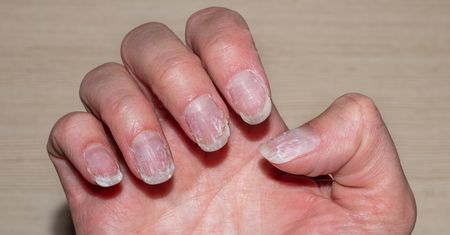 Dodaj do wody i wymocz dłonie. Paznokcie zniszczone po hybrydzie odżyją