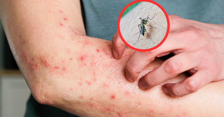 Chikungunya atakuje w Azji. WHO ostrzega przed podróżami