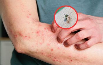Chikungunya atakuje w Azji. WHO ostrzega przed podróżami