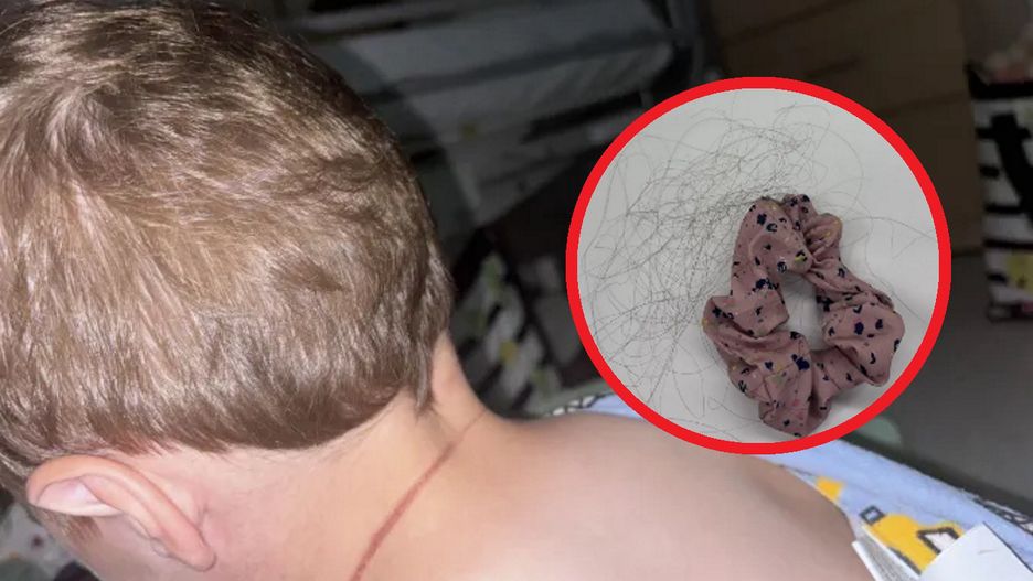 Dziecko przestało oddychać. Wszystko przez włosy