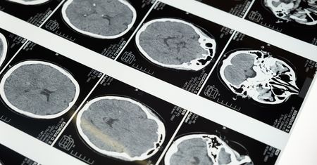 Rewolucyjna metoda. Wykryje chorobę Alzheimera z 17-letnim wyprzedzeniem