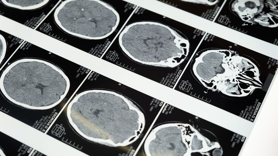 Nowe czujniki pozwolą wykryć chorobę Alzheimera bezobjawowo