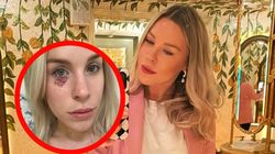 24-latka myślała, że to zaskórnik. Tak objawiał się agresywny rak skóry 