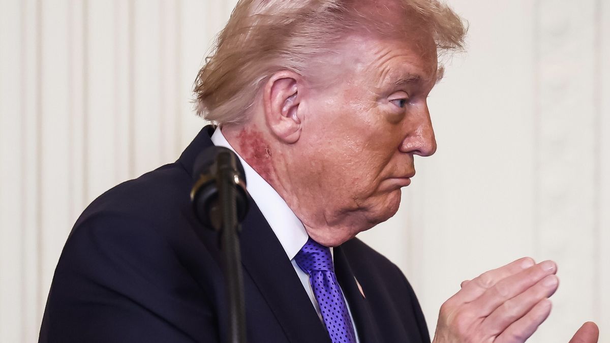 Na szyi Donalda Trumpa widoczne są czerwone plamy