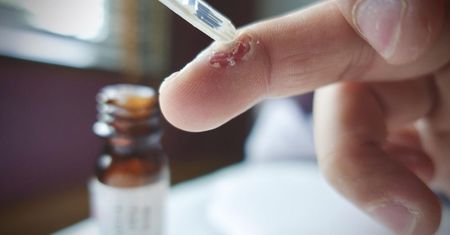 Kwas salicylowy - charakterystyka, źródła kwasu salicylowego, objawy alergii