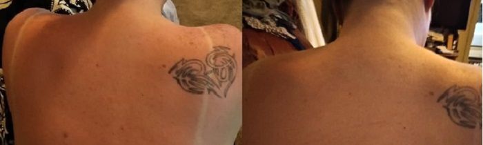 Plecy Cindii przed i po jednorazowym użyciu pianki