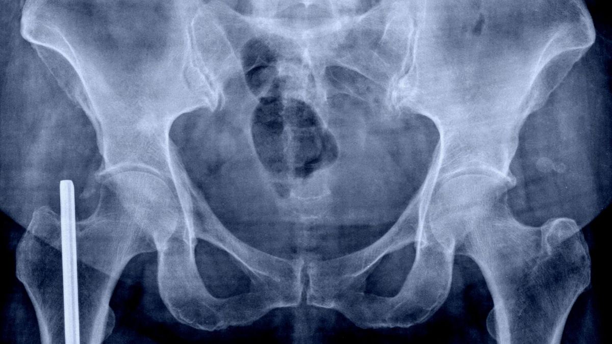 Wegetarianie mają większe ryzyko złamań biodra niż osoby jedzące mięso