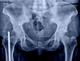 Wegetarianie są bardziej narażeni na złamania kości. Nowe badania