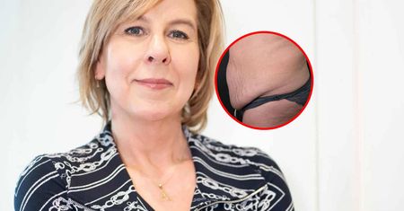 Schudła 25 kg i nie może patrzeć na swój brzuch. Lekarz: jakość życia pacjentki spada