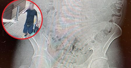 40-latek nerwowo się zachowywał. Oto, co wykazało badanie tomografem
