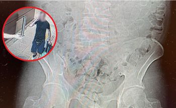 40-latek nerwowo się zachowywał. Oto, co wykazało badanie tomografem